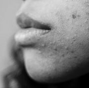 benzoyl peroxide washes