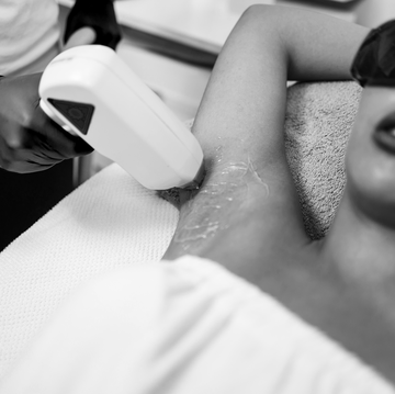 laser hair removal service